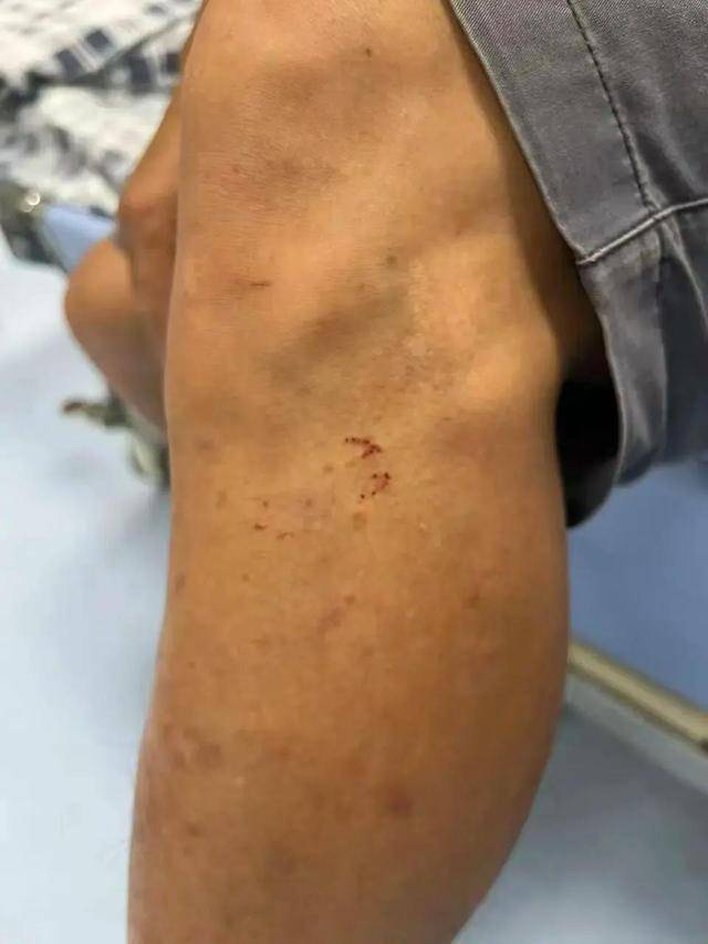 廣東62歲阿叔網(wǎng)魚網(wǎng)到2條眼鏡蛇<strong></p>
<p>宏鑫機(jī)械設(shè)備有限公司
</strong>，被咬傷后當(dāng)場打死，并打包提進(jìn)醫(yī)院:宏鑫機(jī)械設(shè)備有限公司
