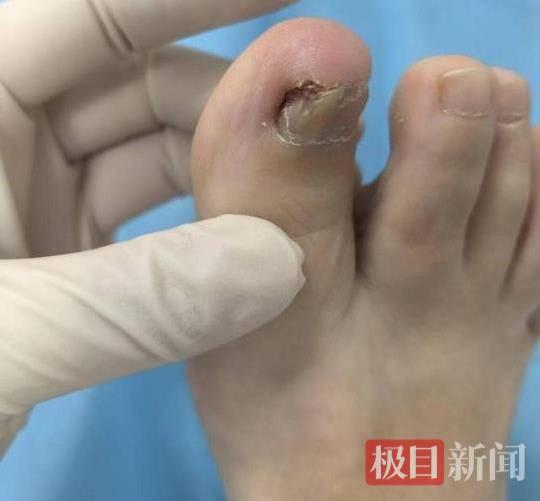 六旬女子被甲溝炎折磨了三年<strong></p>
<p>宏鑫機械設備有限公司
</strong>，專家30分鐘手術解難題:宏鑫機械設備有限公司
